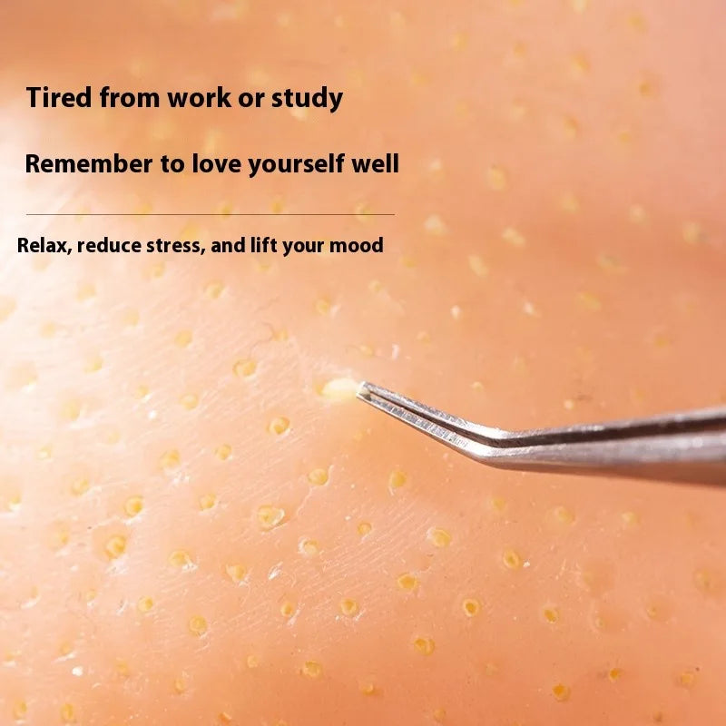 PopZen™ Squeeze Acne Toy — The Most Satisfying Stress-Relief Experience Ever!