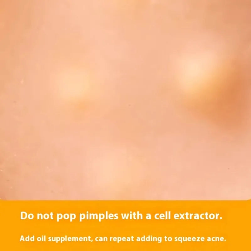 PopZen™ Squeeze Acne Toy — The Most Satisfying Stress-Relief Experience Ever!