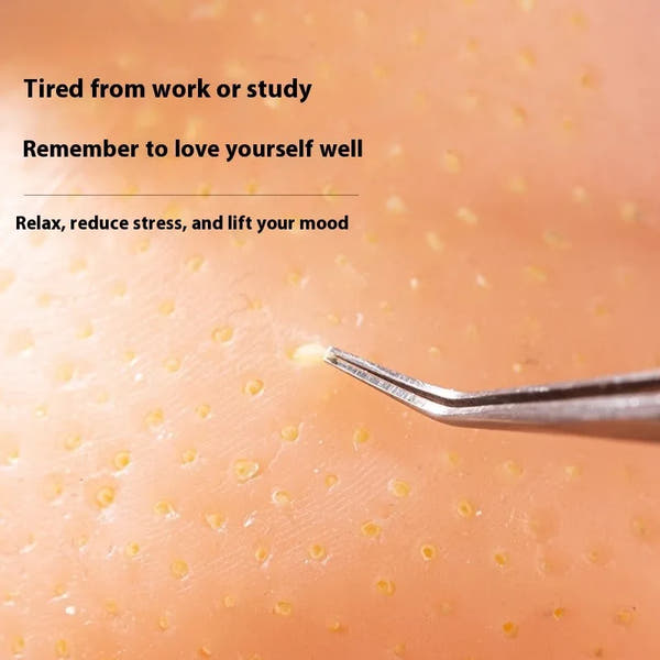 PopZen™ Squeeze Acne Toy — The Most Satisfying Stress-Relief Experience Ever!